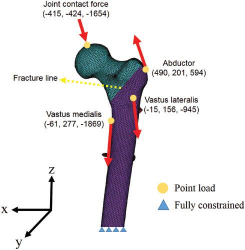 Figure 2: The finite-element models used in this study with AO 31-A2 fracture and the loading and boundary conditions, including the applied load and muscle forces.