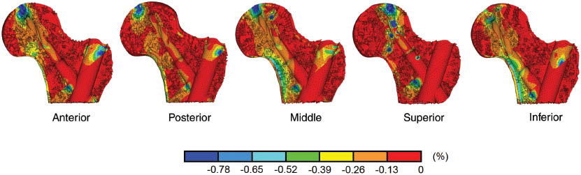Figure 4: Minimum principal strain distribution in cancellous bone in proximal femur presented in percentage for five different blade positions.
