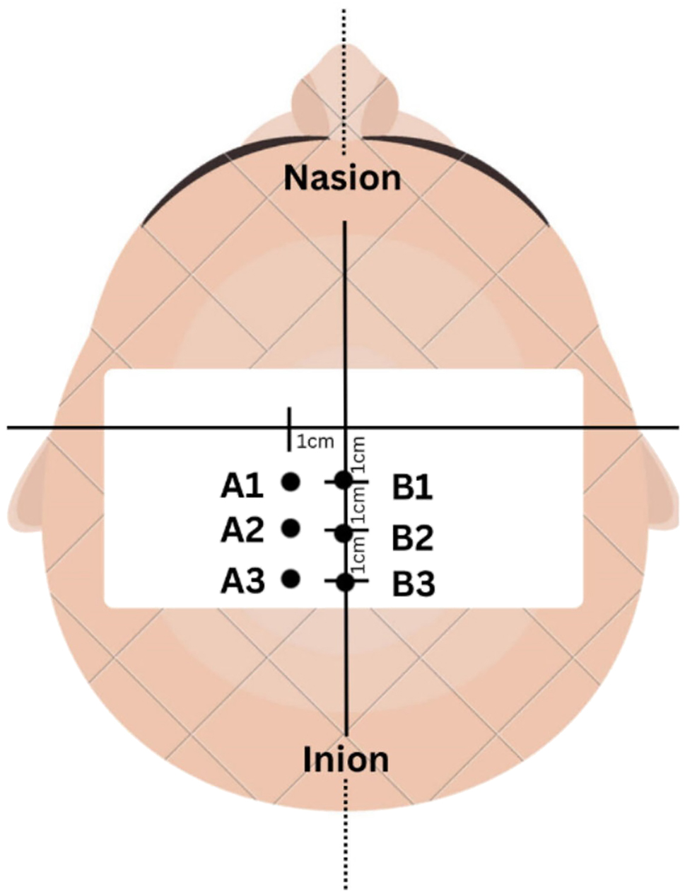 Figure 2: 
TMS stimulation at six points on the motor cortex.
