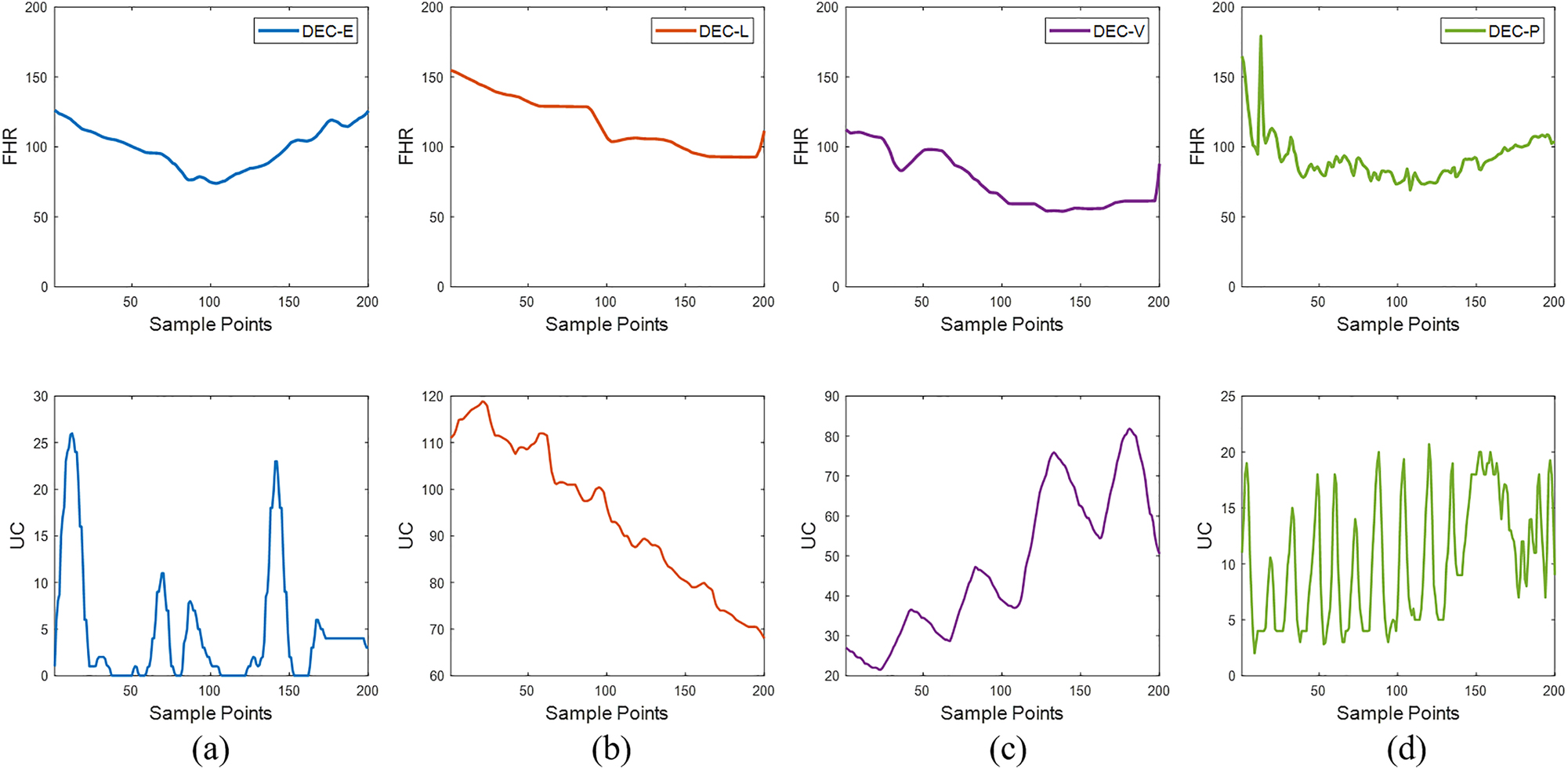 Figure 5: 
The four types of deceleration-specific events, with (a) representing early decelerations, (b) representing late decelerations, (c) representing variable decelerations, and (d) representing prolonged decelerations. The top part represents FHR, and the bottom part represents UC.
