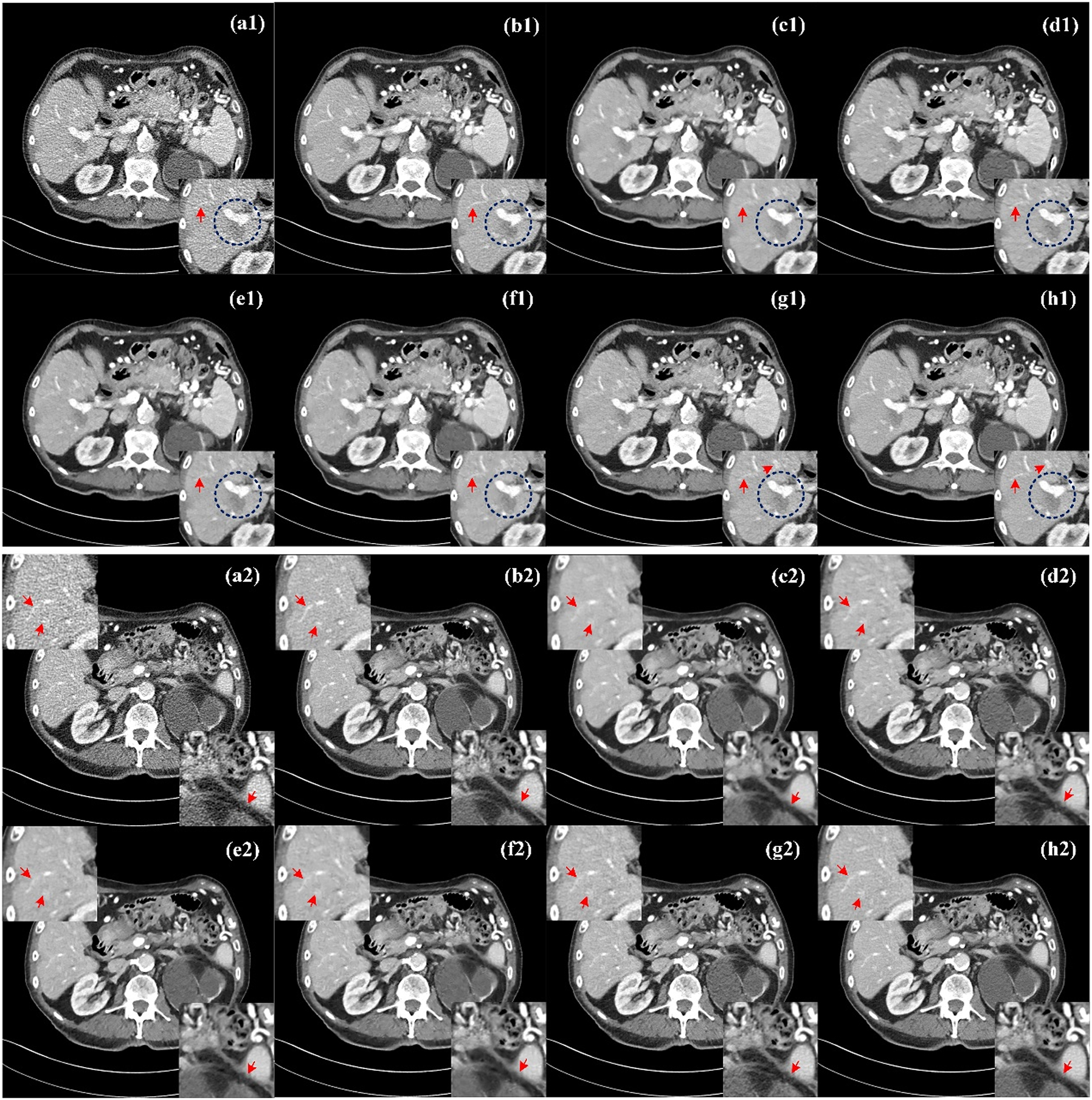 Figure 4: 
Comparison of processed images by different methods for Case 1 and Case 2. (a1, a2) LDCT, (b1, b2) NDCT, (c1, c2) REDCNN, (d1, d2) QAE, (e1, e2) EDCNN, (f1, f2) CTformer, (g1, g2) CoreDiff, (h1, h2) CECDM. ROI1 in the lower right corner of Case 1, ROI2 in the upper left corner of Case 2, and ROI3 in the lower right corner.
