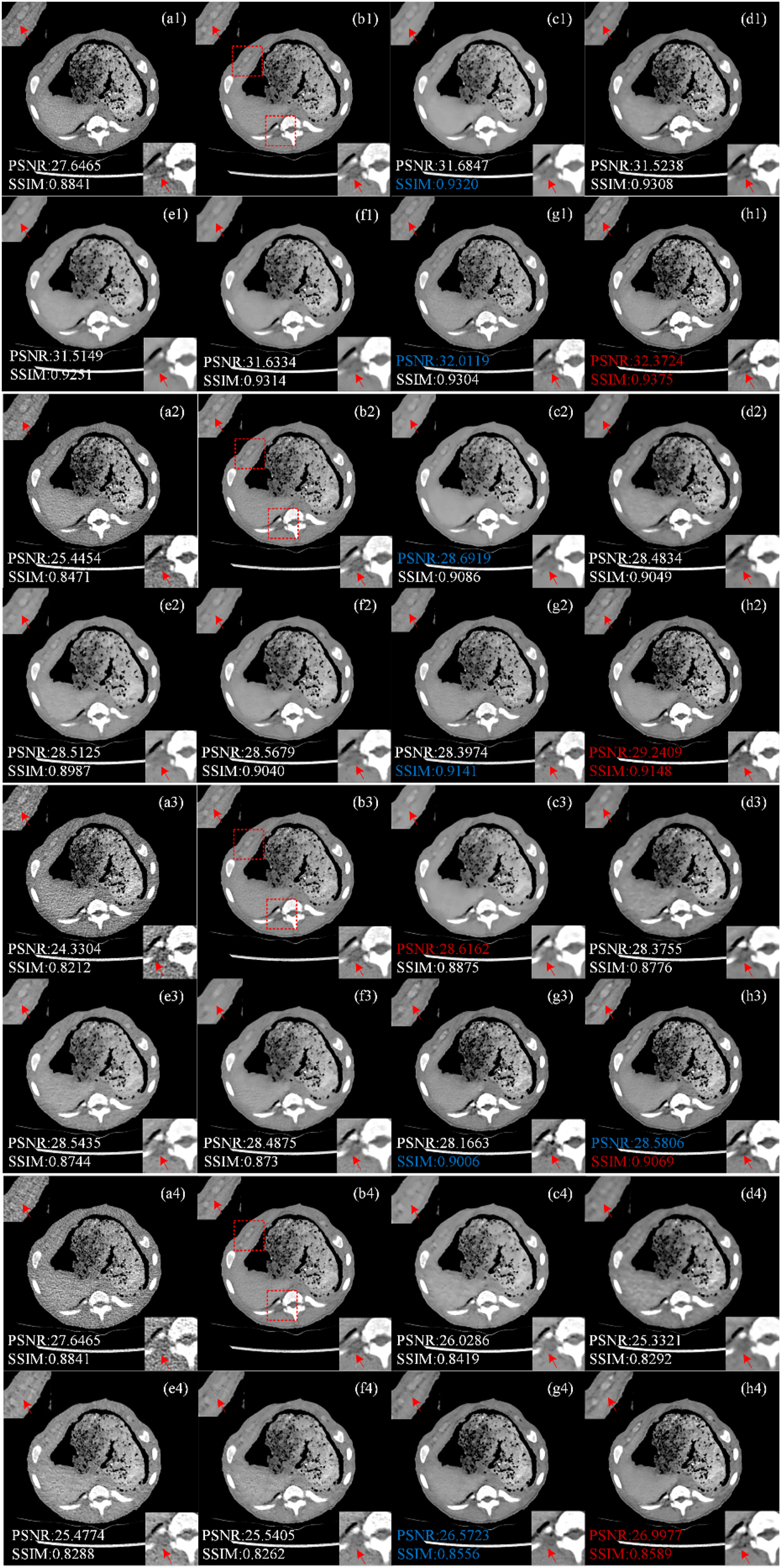 Figure 5: 
Image comparison of different processing methods in piglet dataset. (a1–a4) LDCT (the tube currents are in order 150 mAs, 75 mAs, 30 mAs and 15 mAs), (b1–b4) NDCT, (c1–c4) REDCNN, (d1–d4) QAE, (e1–e4) EDCNN, (f1–f4) CTformer, (g1–g4) CoreDiff, (h1–h4) CECDM.

