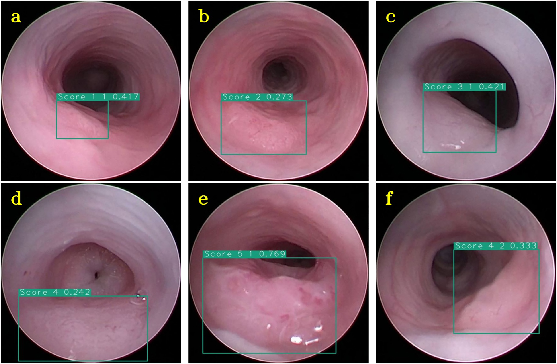 Figure 5: 
Example images of lesion detection network and classification. The green bounding boxes represent the prediction of the neural network. Images (a–e) are correctly classified as lesions with tumor scores ‘1’ – ‘5’; (f) lesion classified falsely as tumor score ‘4’ instead of ‘3’.
