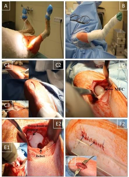Fig. 1: Surgical technique. (A) Sheep positioning in a supine position; (B) Sterile operation field (approx. 15 cm2) around the stifle joint; (C1,2) Medial, 4-5 cm long, parapatellar skin incision from the distal patella pole to approx. 2 cm proximal of the tuberositas tibiae; (C3) Smaller medial incision (2-3 cm) through subcutaneous tissue and joint capsule without luxation of the patella; (D) Exposure of medial femoral condyle (MFC); (E1,2) maximal flexion of the stifle joint; creation of 2 defects (7 mm diameter and 10 mm depth) in the main weight-bearing region of the MFC using a standardized osteochondral punch (OATS); empty defect or OATS-refilled defect; (F1,2) Layer-wise suturing of synovial capsule (interrupted sutures), subcutaneous tissue and skin (continuous sutures); approx. 4 cm long skin suture.