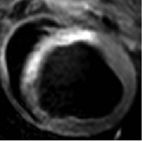 Figure 4 Cardiac magnetic resonance imaging showing a large area of anterior left ventricular fibrosis as a result of a previous myocardial infarction.