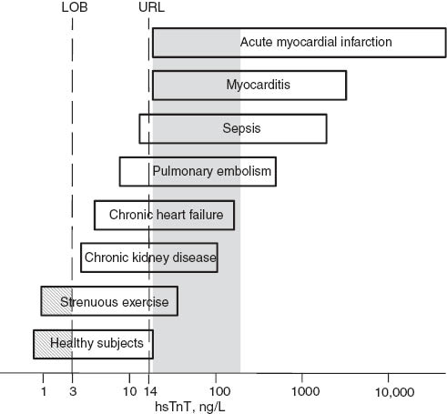 Figure 3 Typical cTnT concentrations for selected cardiac and non-cardiac conditions.cTnT concentrations, measured using the hsTnT assay, are below the 14 ng/L cut-off in 99% of healthy subjects and may exceed 10,000 ng/L in patients with large myocardial infarctions. However, troponin results for many conditions are clustered in the low and medium range of cTnT concentrations, in the area of greatest diagnostic uncertainty highlighted in gray. Concentrations above the gray zone are typically associated with additional clinical, laboratory, ECG and imaging findings and the diagnosis may be established relatively easily. The hsTnT assay detects cTnT in approximately two-thirds of healthy subjects; cTnT concentrations below the limit of blank (LOB, 3 ng/L) are hatched.