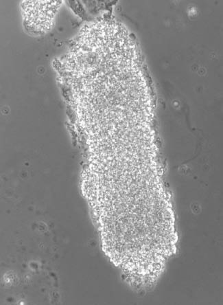 Figure 1:  A finely granular cast (phase contrast microscope, original magnification 400×).By courtesy of Dr. G.B. Fogazzi.