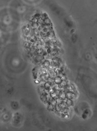 Figure 3:  An erythrocyte cast with packed erythrocytes (phase contrast microscope, original magnification 400×).By courtesy of Dr. G.B. Fogazzi.