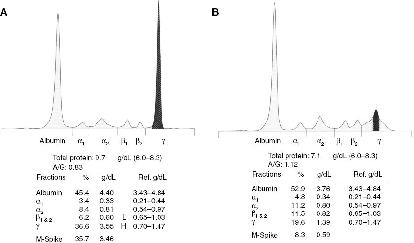 Figure 1: Serum protein CE electropherograms.(A) This serum protein CE electropherogram (Sebia Capillarys) demonstrates a γ-region migrating M-protein (shaded) measuring 34.6 g/L (3.46 g/dL) using the standard perpendicular drop. There is suppression of the polyclonal immunoglobulins in this case, so the M-protein measurement is only minimally contaminated with co-migrating polyclonal immunoglobulins. (B) This serum protein CE electropherogram (Sebia Capillarys) demonstrates a γ-region migrating M-protein (shading) measuring 5.9 g/L (0.59 g/dL) using the standard perpendicular drop (shaded). However, about two-thirds of the measured quantity of the standard perpendicular drop is due to polyclonal immunoglobulins that co-migrate with the M-protein and falsely increase the M-protein measurement.
