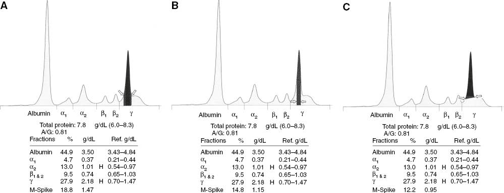 Figure 2: Serum protein CE electropherograms (Sebia Capillarys) showing three methods of measuring M-protein peaks.(A) Standard perpendicular drop method (shaded) where the demarcation begins where the M-spike meets the polyclonal region below it (arrows) and then proceeds straight down to the baseline including all the area above and below. This measures 14.7 g/L (1.47 g/dL) and is the most frequently used technique currently. (B) Corrected perpendicular drop where an attempt is made to narrow the area measured to compensate for the inclusion of the polyclonal area below. The same M-spike here measures 11.5 g/L (1.15 g/dL). (C) Tangent skimming method described by Schild et al. on the Sebia Capillarys [46]. As shown by the arrows, this method attempts to cut off only the area above the peak. The M-protein now measures 9.5 g/L (0.95 g/dL). It works well in the γ region.