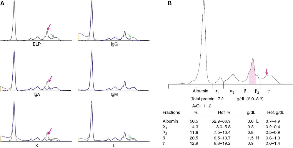 Figure 4: (A) This ISUB (Sebia Capillarys) of serum shows six electropherogram images of serum from a patient being treated for IgAK multiple myeloma. The top left image is the protein electrophoresis (ELP) which has a black line indicating the electropherogram of this serum. The other five images show the result of subtracting the indicated immunoglobulin by preincubating the serum with specific antiserum prior to performing the ISUB. There are two lines that largely superimpose on these five images. The black line is the ELP pattern repeated on each image. However, a blue line is also present on these five images that shows what has happened following the immunosubtraction. Where the two lines overlap, one sees only the blue line. But when there is a difference, the difference between the blue and black lines shows the area that has been subtracted. This patient has a modest M-spike in the β region on the ELP image. A pink arrow points to this area in the ELP, IgA and K images. Under these arrows in the IgA and K images note that the blue lines go down to the two normal β region proteins (transferrin and C3) while the original black line remains above them. This indicates that the M-spike is composed of IgAK and the amount subtracted corresponds to the amount of the M-protein. Note also that a tiny restriction can be seen in the γ region (green arrows). This area is not subtracted by IgA or κ, but is subtracted by IgG and λ. It represents a small oligoclonal band commonly seen following autologous stem cell transplantation. (B) The measured area in the β region in this CE electropherogram from the same serum as in 4A is shaded in pink (the corrected perpendicular drop). It was estimated by observing the area subtracted in the IgA image of Figure 4A. The arrow in the γ region indicates the tiny band noted above that likely reflects a reactive oligoclonal process. It is too small to measure.