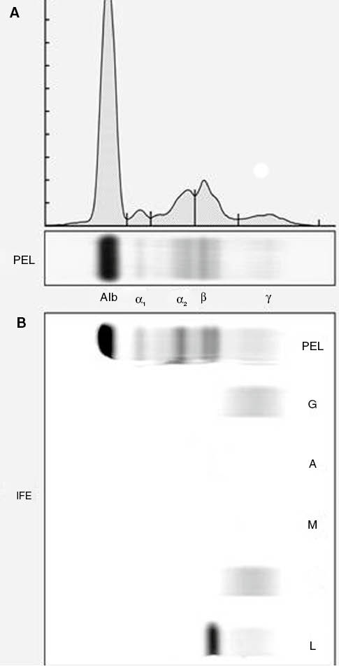 Figure 1: Protein electrophoresis and immunofixation. (A) Serum protein electrophoresis of a patient with a λ light chain only multiple myeloma. A small M-protein is seen in the β-fraction. (B) Immunofixation is performed on the same patient. A λ band is seen on the immunofixation which corresponds to the peak seen in the β-fraction of the protein electrophoresis.