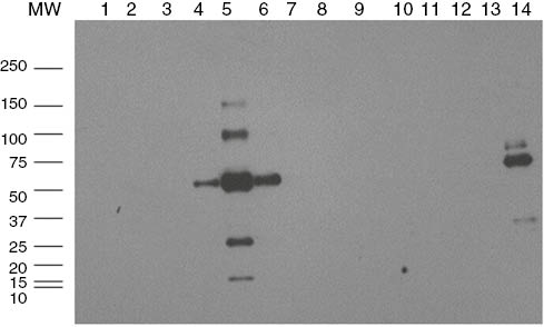 Figure 3: Western blot performed with anti-λ light chain on urinary exosomes from a patient with amyloidosis (AL) with monoclonal λ light chain.The lanes represent fractions separated by ultracentrifugation with sucrose deuterium oxide gradient. Lanes four to six represent the glomerular fractions and lane 14 is the entire spun pellet. Oligmeric λ light chain species are seen at 50, 100, and 150 kDa. No κ light chain was seen (data not shown).