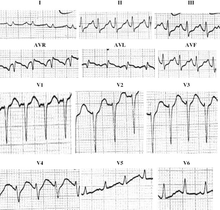 Figure 2: Electrocardiogram of Kounis syndrome following rubella vaccination (unpublished data).Sinus tachycardia, low voltage, ST elevation in I and AVL, T inversion in V5–V6 with diminished R wave in V1–V4 leads, minutes after an allergic reaction to rubella vaccination and 2 h before sudden death. Coronary histology showed infiltration of coronary intima, media and adventitia by numerous eosinophils and mast cells.