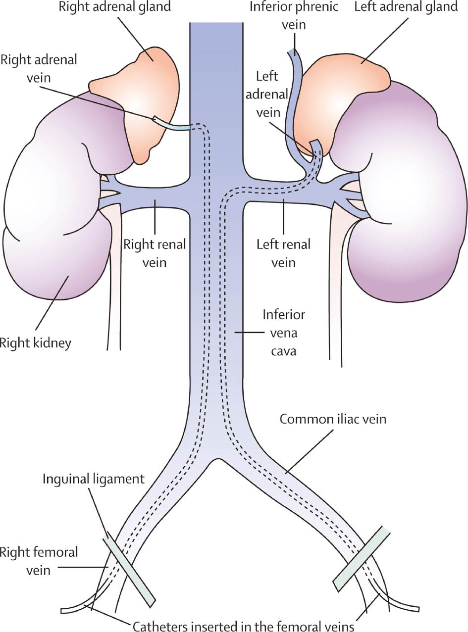Figure 2: Schematic description of adrenal vein anatomy and adrenal vein sampling [52].