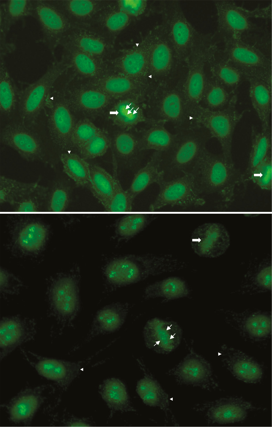 Figure 2: General characteristic features of the Topo I-like HEp-2 IFA pattern (AC-29).Indirect immunofluorescence on HEp-2 cells with human serum with reactivity to DNA topoisomerase I diluted 1:100. Magnification ×400. Slides from Inova Diagnostics (upper panel) and MBL (lower panel). Interphase nuclei are stained with fine speckled pattern. Metaphase chromatin plate is stained with a compact fine specked pattern (large arrows) as well as with three to eight tiny discrete dots representing the nucleolar organizing regions (small arrows). Upper panel: the cytoplasm depicts a faint weblike staining pattern spanning from the nuclear periphery to the plasma membrane region (arrowheads). Lower panel: the staining of the nucleoli is variable according to the HEp-2 cell preparation.
