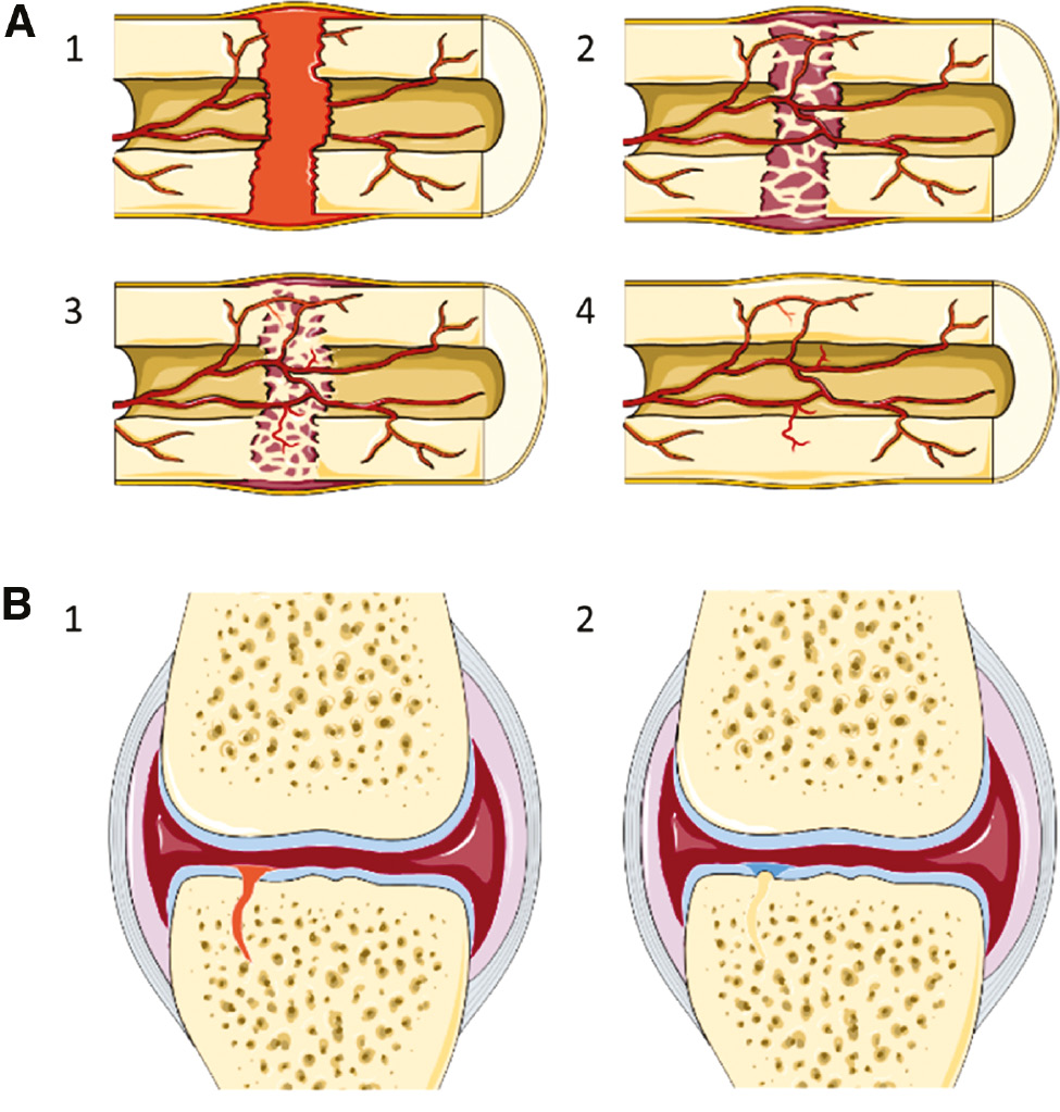 Figure 1: The phases in bone fracture healing and intra-articular fracture healing.
(A) The four phases of bone fracture healing are (1) hematoma (fibrin clot) formation, (2) soft callus formation, (3) hard callus formation, and (4) bone remodeling. This healing process results in the complete restoration of the structure and long-term function of the bone. (B) The two main phases of the healing response of the bone in intra-articular fractures are (1) fibrin clot formation to fill the defect and (2) bone formation in the osseous part and fibrocartilage formation in the chondral part. The structure of the fibrocartilage is significantly different from the original articular cartilage and will often fail. The healing response from the bone in intra-articular fractures does not result in long-term restoration of joint structure and function.