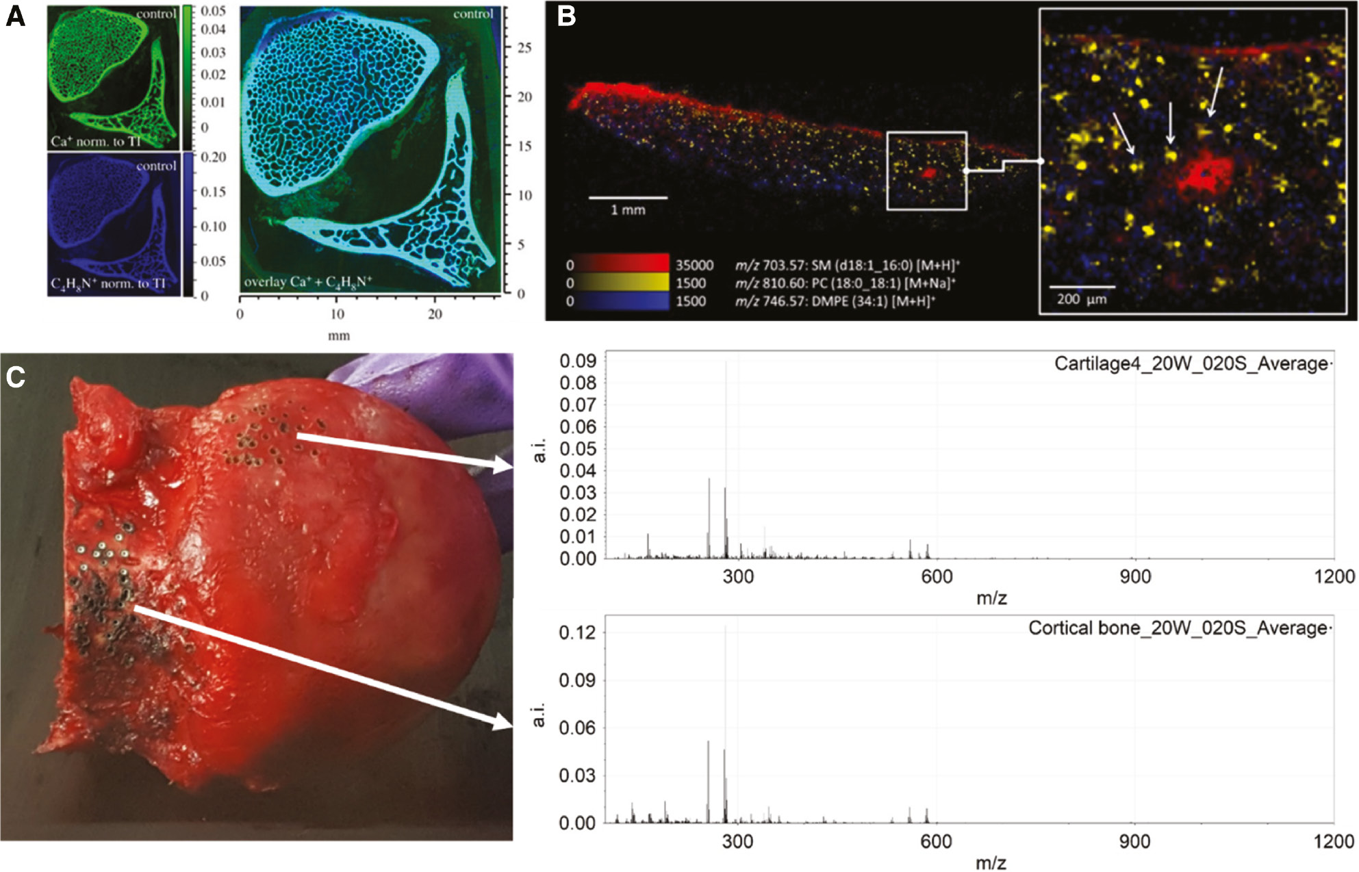 Figure 3: Examples of application of mass spectrometry for the direct analysis of hard tissues, namely ToF-SIMS on bone, MALDI-MSI on cartilage, and CO2 laser coupled to REIMS on bone and cartilage.
(A) ToF-SIMS image of healthy sheep vertebra showing Ca+ (inorganic compound), C4H8N+ (organic compound), and overlay of the selected m/z values. ToF-SIMS measurement was performed with a Bi3+-primary ion beam and a lateral resolution of 10 μm. Reprinted with permission from Müller et al. [65]. (B) MALDI-MSI image of osteoarthritic cartilage showing an overlay image of SM (d18:1_16:0) in the damaged superficial part of the tissue, PC (18:0_18:1) specific for chondrocytes, and DMPE (34:1) in the matrix of the tissue. The arrows point at chondrocyte pellets. MALDI-MSI image was taken at a spatial resolution of 15 μm. Reprinted with permission from Barré et al. [70]. (C) Mass spectra for the mass range m/z 500–1200 obtained from a human femoral head with a CO2 laser (continuous wave with a laser power of 20 W with a pulse duration of 0.20 s) coupled to REIMS from cartilage (top) and cortical bone (bottom).
