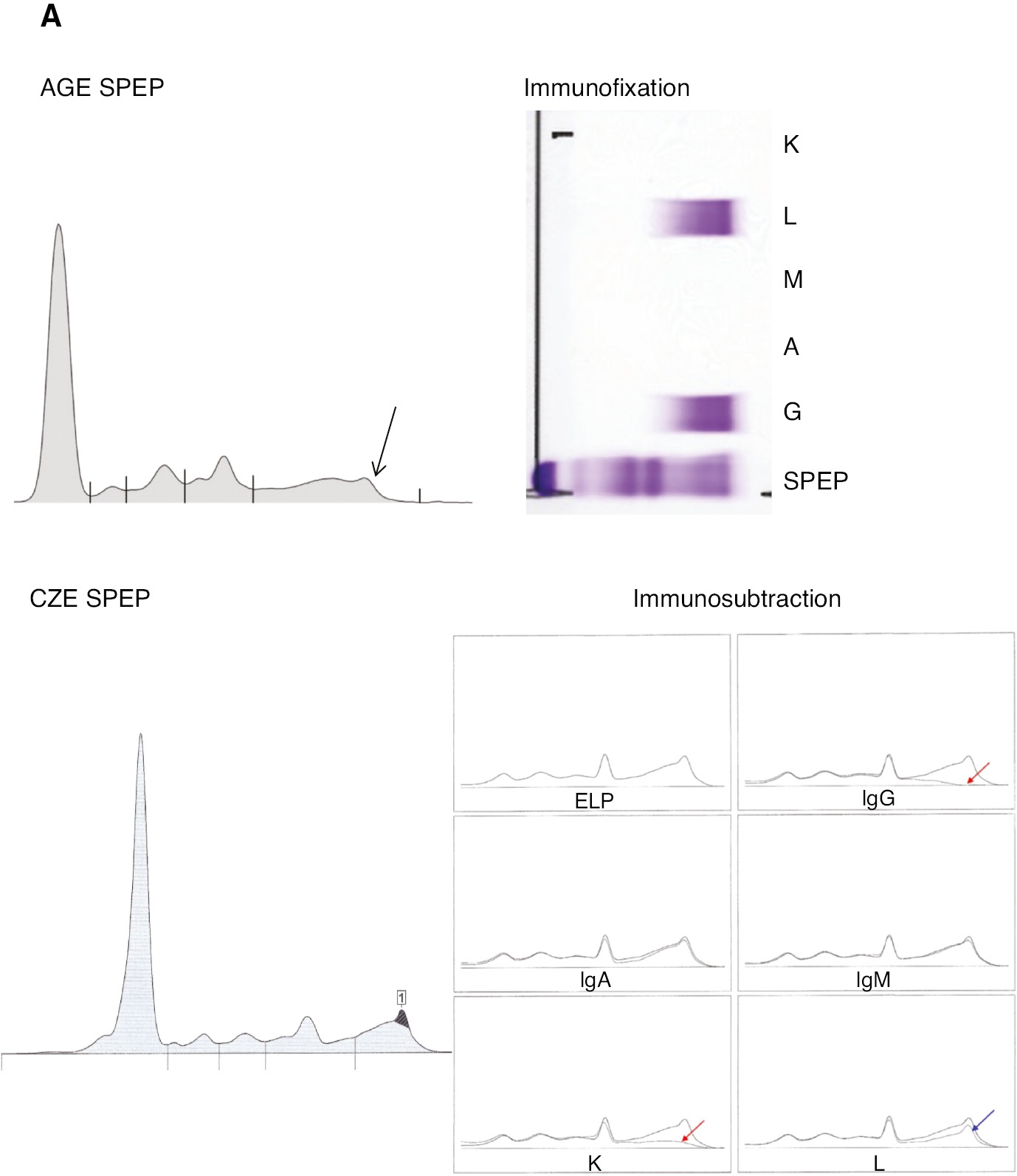 Figure 1: Representative immunofixation electrophoresis and immunosubtraction in a normal-gamma polyclonal background.
Images show the SPEP electropherogram and isotype of three M-proteins. Both Dara and Elo are IgG-k biologics, Dara migrates at the cathodal end of the gamma fraction and Elo migrates in the center of the gamma fraction. The IgAλ M-protein be identified as a distinct peak migrating in the beta region. (A) Daratumumab (1 g/L). AGE SPEP (Helena Laboratories), IFE (Sebia), CZE SPEP and ISUB (Sebia Capillarys) are represented. There is subtraction of the M-protein spike by anti-IgG and anti-kappa (red arrows), but with anti-lambda, although polyclonal lambda immunoglobulins are subtracted, the spike remains (blue arrow). (B) Elotuzumab (1 g/L). AGE SPEP (Helena Laboratories), IFE (Sebia), CZE SPEP and ISUB (Sebia Capillarys) are represented. There is subtraction of the M-protein spike by anti-IgG and anti-kappa (red arrows), but with anti-lambda, although polyclonal lambda immunoglobulins are subtracted, the spike remains (blue arrow). (C) Beta-migrating IgAλ M-protein. AGE SPEP (Helena Laboratories), IFE (Sebia), CZE SPEP and ISUB (Sebia Capillarys) are represented. There is subtraction of the M-protein spike by anti-IgA and anti-lambda (red arrows), but with anti-kappa, although polyclonal lambda immunoglobulins are subtracted, the spike remains (blue arrow).