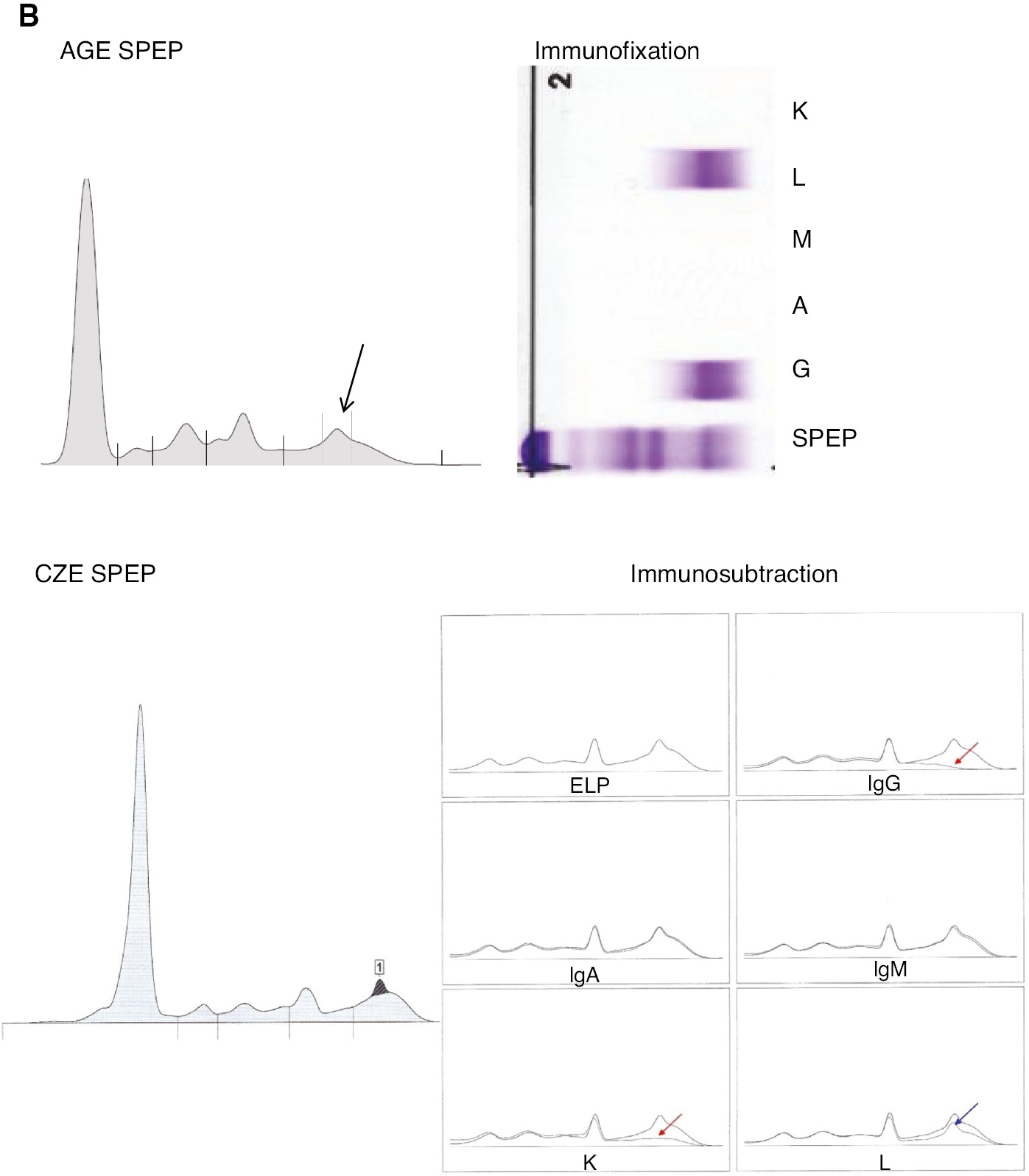 Figure 1: Representative immunofixation electrophoresis and immunosubtraction in a normal-gamma polyclonal background.
Images show the SPEP electropherogram and isotype of three M-proteins. Both Dara and Elo are IgG-k biologics, Dara migrates at the cathodal end of the gamma fraction and Elo migrates in the center of the gamma fraction. The IgAλ M-protein be identified as a distinct peak migrating in the beta region. (A) Daratumumab (1 g/L). AGE SPEP (Helena Laboratories), IFE (Sebia), CZE SPEP and ISUB (Sebia Capillarys) are represented. There is subtraction of the M-protein spike by anti-IgG and anti-kappa (red arrows), but with anti-lambda, although polyclonal lambda immunoglobulins are subtracted, the spike remains (blue arrow). (B) Elotuzumab (1 g/L). AGE SPEP (Helena Laboratories), IFE (Sebia), CZE SPEP and ISUB (Sebia Capillarys) are represented. There is subtraction of the M-protein spike by anti-IgG and anti-kappa (red arrows), but with anti-lambda, although polyclonal lambda immunoglobulins are subtracted, the spike remains (blue arrow). (C) Beta-migrating IgAλ M-protein. AGE SPEP (Helena Laboratories), IFE (Sebia), CZE SPEP and ISUB (Sebia Capillarys) are represented. There is subtraction of the M-protein spike by anti-IgA and anti-lambda (red arrows), but with anti-kappa, although polyclonal lambda immunoglobulins are subtracted, the spike remains (blue arrow).
