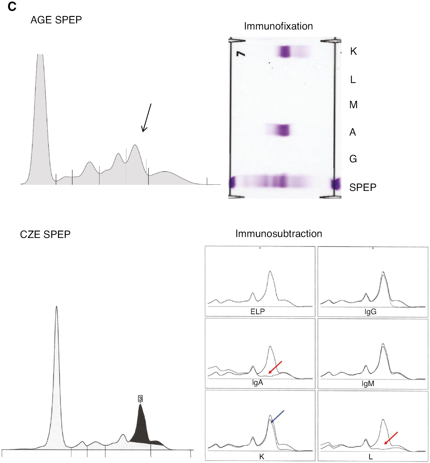 Figure 1: Representative immunofixation electrophoresis and immunosubtraction in a normal-gamma polyclonal background.
Images show the SPEP electropherogram and isotype of three M-proteins. Both Dara and Elo are IgG-k biologics, Dara migrates at the cathodal end of the gamma fraction and Elo migrates in the center of the gamma fraction. The IgAλ M-protein be identified as a distinct peak migrating in the beta region. (A) Daratumumab (1 g/L). AGE SPEP (Helena Laboratories), IFE (Sebia), CZE SPEP and ISUB (Sebia Capillarys) are represented. There is subtraction of the M-protein spike by anti-IgG and anti-kappa (red arrows), but with anti-lambda, although polyclonal lambda immunoglobulins are subtracted, the spike remains (blue arrow). (B) Elotuzumab (1 g/L). AGE SPEP (Helena Laboratories), IFE (Sebia), CZE SPEP and ISUB (Sebia Capillarys) are represented. There is subtraction of the M-protein spike by anti-IgG and anti-kappa (red arrows), but with anti-lambda, although polyclonal lambda immunoglobulins are subtracted, the spike remains (blue arrow). (C) Beta-migrating IgAλ M-protein. AGE SPEP (Helena Laboratories), IFE (Sebia), CZE SPEP and ISUB (Sebia Capillarys) are represented. There is subtraction of the M-protein spike by anti-IgA and anti-lambda (red arrows), but with anti-kappa, although polyclonal lambda immunoglobulins are subtracted, the spike remains (blue arrow).