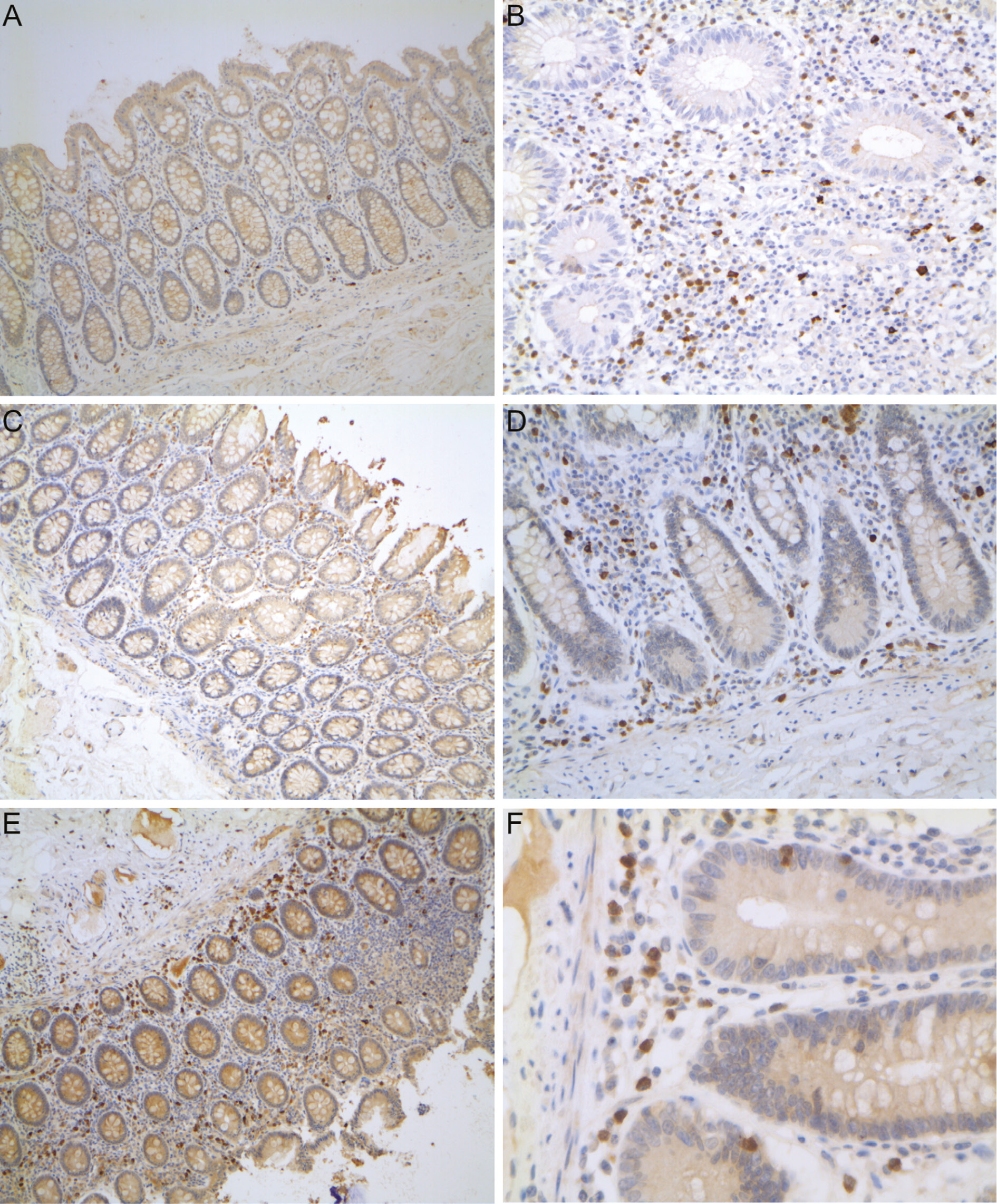 Figure 2: Adenomatous polyposis coli (APC) immunohistochemistry.
In the left side the colon mucosa of a patient with colorectal cancer (A), a patient with UC (C) and a patient with CD (E) are shown. In the right side of the figure the ileum mucosa of CD patients are shown. In CD, APC positively stained cells (in brown) are highly represented in the stroma of the inflamed ileum (B, D and F), but also in the non-inflamed colon (C), and they are preferentially localised towards the muscolaris mucosae. In UC the same APC positive cells are mainly localised towards the surface epithelium.