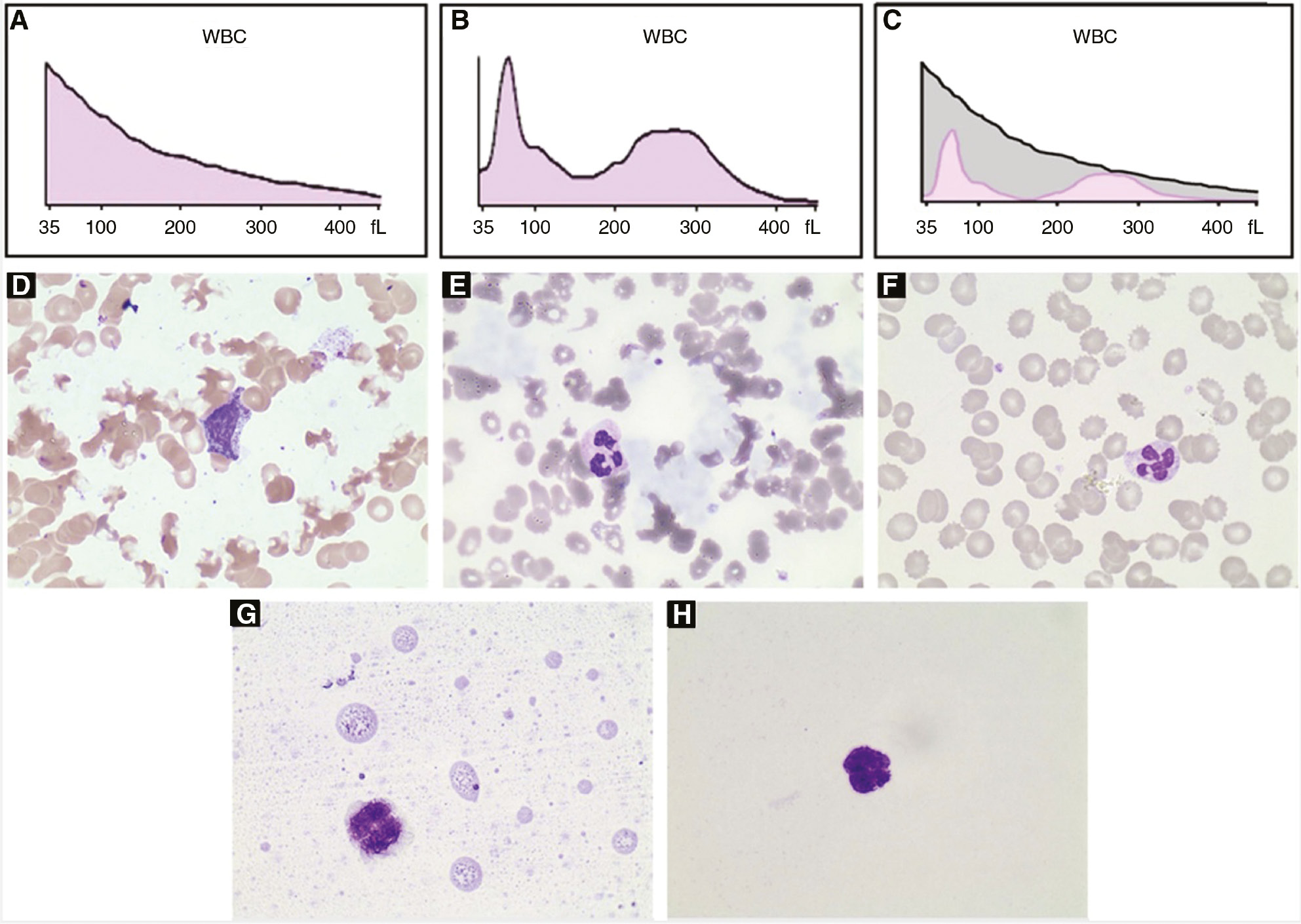 Figure 1: WBC histograms and peripheral blood smears of the patient’s sample.
(A–C) WBC histograms. (A) At room temperature. (B) 37°C for 30 min. (C) The merged image. (D–H) Blood smear (Wright-Giemsa stain; ×1000). (D) Prepared by the Coulter DxH Slidemaker Stainer at room temperature. (E) Prepared manually at room temperature. (F) Prepared manually after the blood was heated to 37°C for 30 min. (G) and (H) The additional experiment. (G) This case. (H) Normal control.