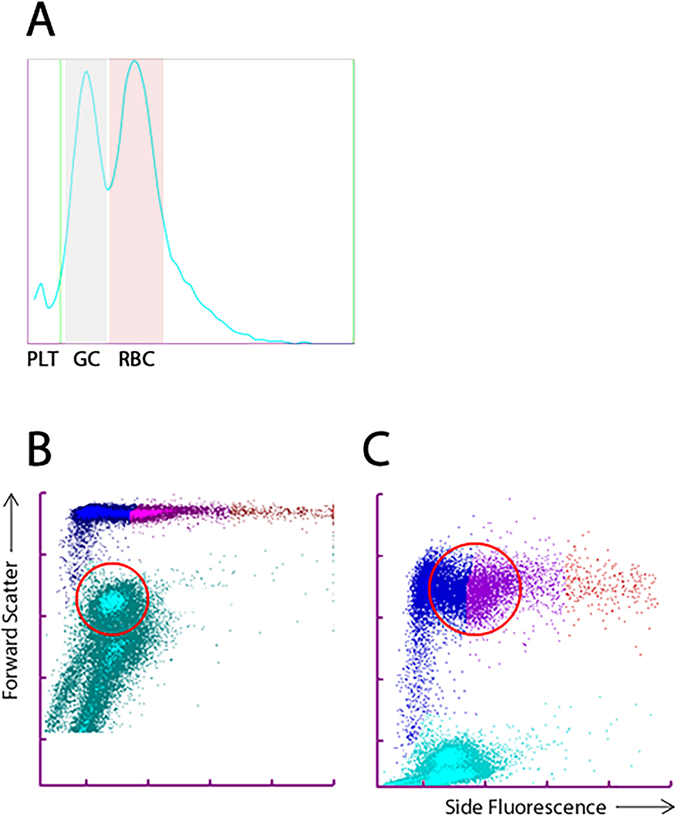 Figure 1: 
Sysmex XN1000 hematology analyzer results during Clostridium perfringens sepsis.
(A) Histograms illustrating a microcytic population of erythrocytes (ghost cells) in case B. Similar histograms were seen in case A on the Siemens Advia 2120i. (B) The ghost cells (encircled) were misidentified as platelets due to their reduced size in the optical platelet count. (C) The spherocytes (encircled) showed a marked interaction with the polymethine dye used in the reticulocyte channel, leading to misidentification as mature reticulocytes. One would normally expect to find predominantly young reticulocytes (orange population on the far right) in severe hemolysis. Abbreviations: PLT, platelets; GC, ghost cells; RBC, red blood cells.

