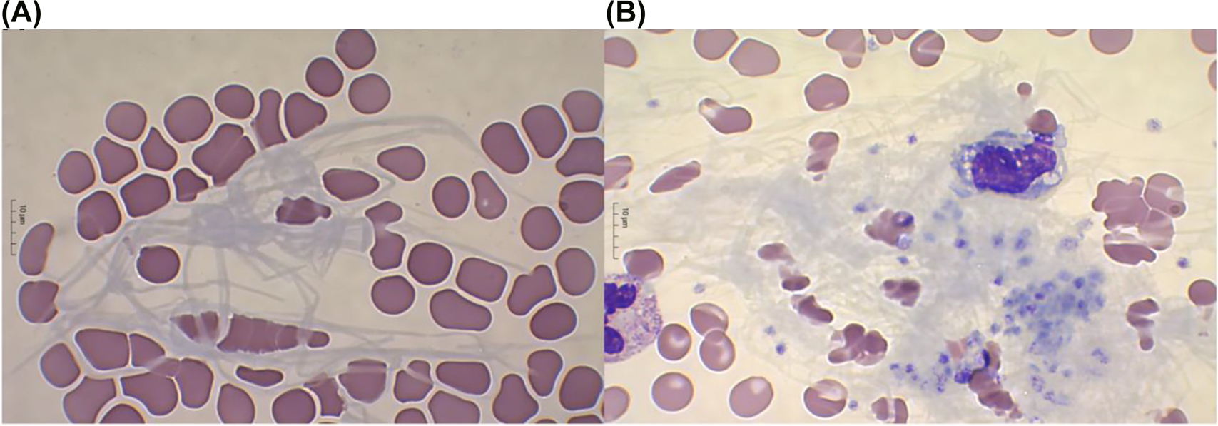 Figure 1:
Fibrin strands.
(A) Fibrin strands in peripheral blood smear. (B) Fibrin strands with platelets and a white blood cell clumped together in peripheral blood smear.
