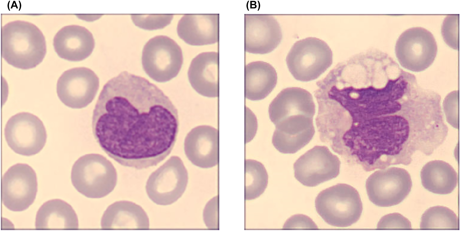 Figure 2: 
Light microscopy images of peripheral blood WBC representative of COVID-19 negative (A) and positive patients (B). Normal monocytes show only occasional and very small cytoplasmic vacuoles, compared to the atypical monocytes with large coalescing cytoplasmic vacuoles typically found in SARS-CoV-2 patients. (May-Grunwald-Giemsa, ×100) (personal unpublished observations).
