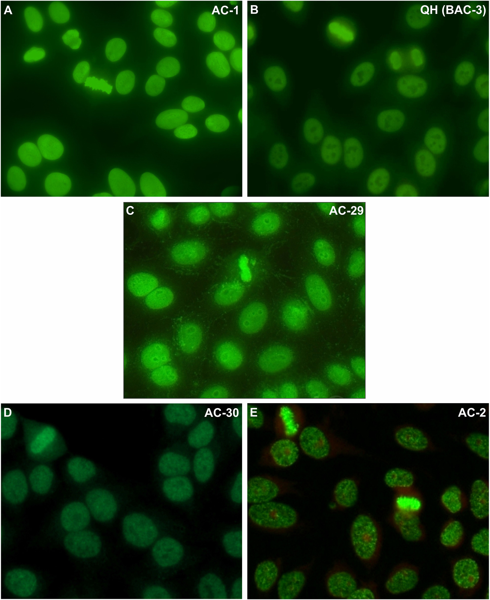 Figure 1: 
Morphological details of the nuclear patterns that show homogeneous or speckled staining of the metaphase plate: nuclear homogeneous – AC1 (A), nuclear quasi-homogeneous - BAC-3 (B), DNA topoisomerase I/topo I-like – AC-29 (C), nuclear fine speckled with mitotic plate - AC-30 (D), and nuclear dense fine speckled – AC-2 (E). Images from the International Consensus on ANA Patterns, photographs (C) and (E): Werner Klotz & Manfred Herold (Sample dilution: 1:80; microscope magnification: 400×).

