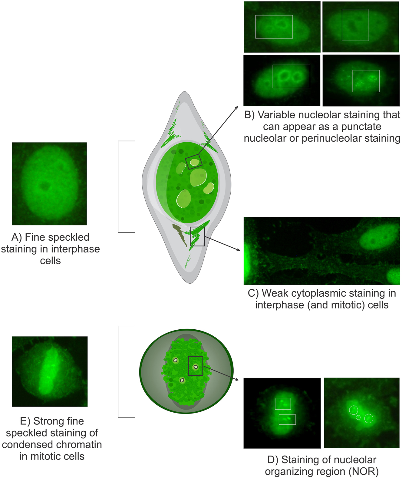 Figure 2: 
Morphological characteristics of the Topo I-like pattern: The Topo I-like pattern is defined by staining across five distinct subcellular regions. (A) Prominent extremely fine and compact speckled staining in interphase nuclei. (B) Variable nucleolar staining, which may present as punctate nucleolar, homogeneous or perinucleolar staining in interphase cells, although this feature is not consistently observed. (C) Faint cytoplasmic staining in interphase and mitotic cells, forming a delicate network radiating from the perinuclear area to the plasma membrane. (D) Intense staining of NOR over condensed chromosomes in mitotic cells, though this can be obscured by bright chromosomal staining. (E) Strong extremely fine compact speckled staining of condensed chromatin in mitotic cells, which may appear homogeneous with high titer samples. Images sourced from the International Consensus on ANA Patterns (www.ANAPatterns.org), photographs by Werner Klotz & Manfred Herold.
