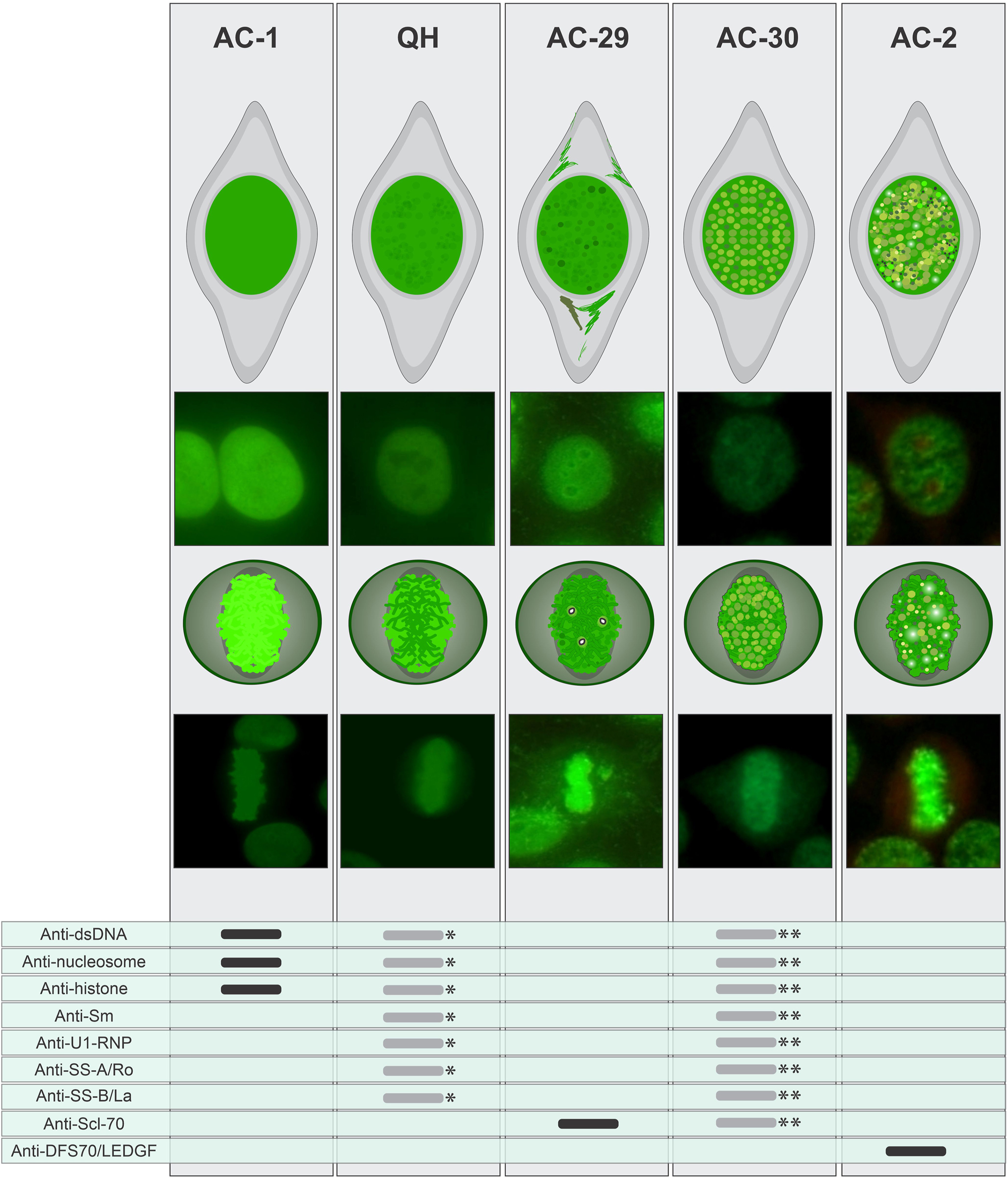 Figure 3: 
Comparison of morphological characteristics of the AC-1, BAC-3 (QH), AC-29, AC-30, and AC-2 patterns presenting a comparative analysis of the morphological features of the patterns, focusing on the staining in interphase nucleus, metaphase plate, and the reactivity of autoantibodies against immunogenic targets. *If the patient exhibits clinical manifestations suggestive of SARD, further testing for antibodies to dsDNA, nucleosome, SS-A/Ro, SS-B/La, U1-RNP, and Sm is recommended, guided by the most likely autoimmune diseases under consideration.**The AC-30 may exhibit reactivity to dsDNA, nucleosomes, histones, Sm, U1-RNP, Scl-70, SS-A/Ro, and SS-B/La in approximately one-fourth of cases, warranting additional investigation guided by the most likely autoimmune diseases under consideration.
