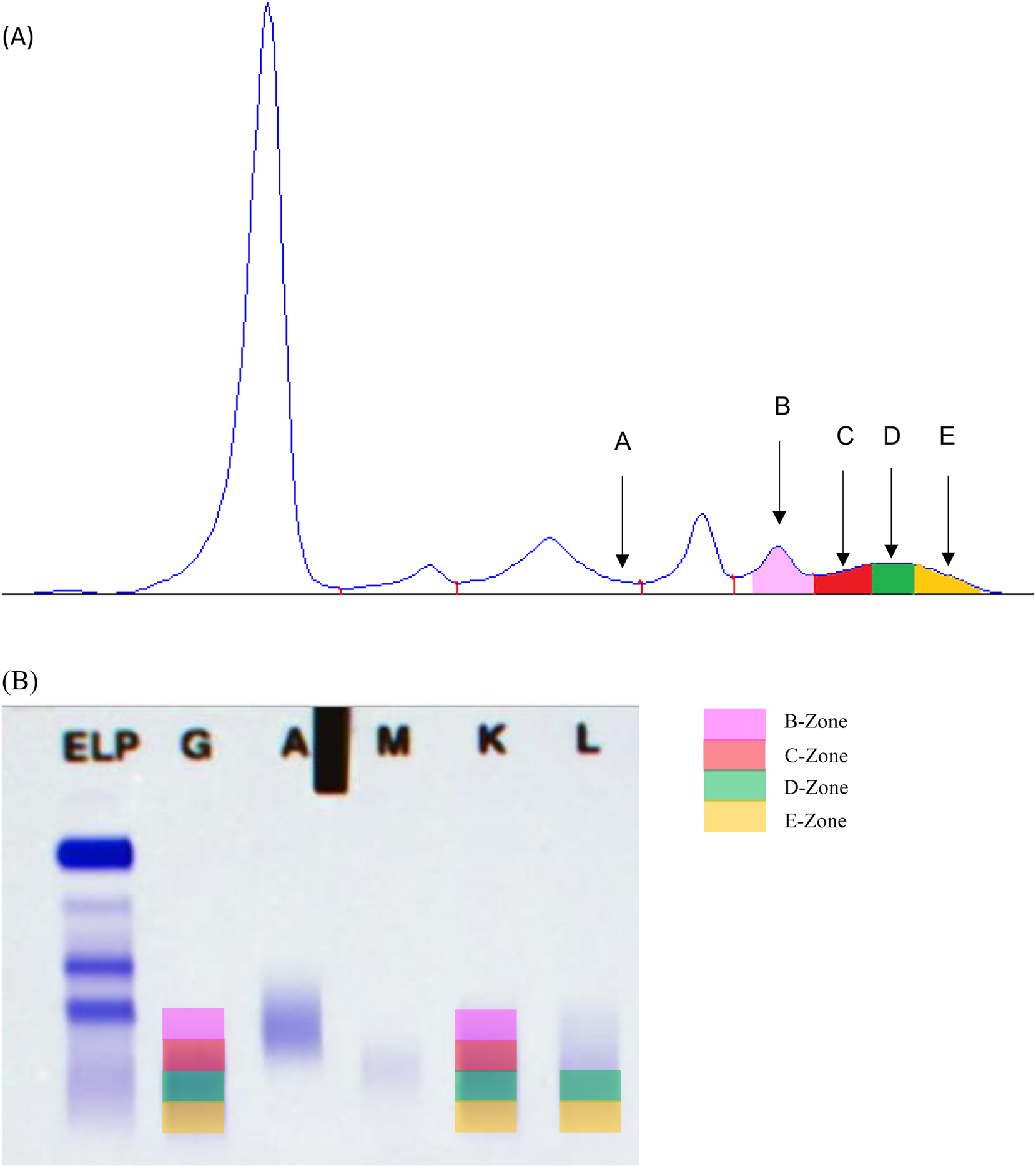 Figure 2: 
Electrophoretic migration zones of therapeutic monoclonal antibodies. (A) Serum protein capillary electrophoresis. A-zone: abatacept; C-zone: casirivimab, elotuzumab, isatuximab, panitumumab; D-zone: belantamab mafodotin, bevacizumab, cilgavimab, infliximab, natalizumab, siltuximab, teclistamab, tixagevimab, vedolizumab; E-zone: bamlanivimab, daratumumab, denosumab, etesevimab, imdevimab, ofatumumab, rituximab, sotrovimab, tocilizumab, trastuzumab. (B) Serum protein immunofixation. B-zone: eculizumab; C-zone: casirivimab, elotuzumab, isatuximab; D-zone: adalimumab, belantamab mafodotin, bevacizumab, cetuximab, cilgavimab, infliximab, pembrolizumab, pemivibart, siltuximab, tecistamab, tixagevimab, vedolizumab; E-zone: bamlanivimab, daratumumab, denosumab, etesevimab, imdevimab, nivolumab, ofatumumab, rituximab, sotrovimab, trastuzumab.
