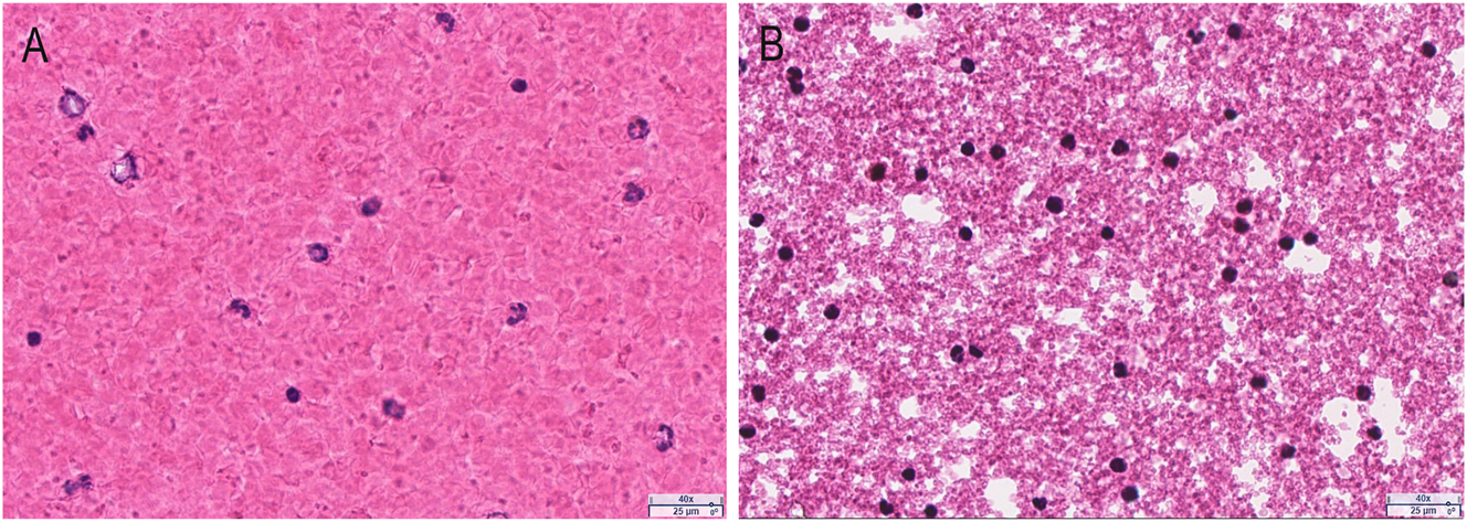 Figure 2:
The pellet from PAXgene RNA blood samples (40 × magnification). The smear slides were prepared from EDTA blood (A) and the pellet suspension from PAXgene RNA blood samples (B). After staining with H&E, the slides were scanned using the aperio AT2 whole slide scanner.