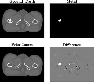 Figure 1 The used phantom. Ground truth image of the image that is to be reconstructed, which shows a region around the pectoral girdle. Segmentation of the metal object. The used prior image, which is located approx. 1 cm underneath the ground truth image. The difference of the ground truth image and the prior image.