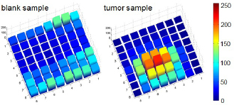 Figure 5 3D bar graphs showing the sensor output for palpation tests on hepatic specimen. It is obvious that the left graphic shows the results for a blank sample without an inclusion whereas the presence of a tumor can clearly be confirmed for the right graphic due to the increased values occuring at the taxels in the middle and the lower left corner of the sensor.