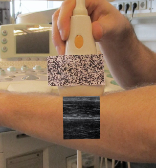 Figure 2 View through the smart glasses. On top the ultrasound transducer with the attached optical marker. Below the corresponding ultrasound image.