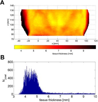 Figure 4 Segmentation result for subject 3. A: 3D skin surface over-laid with color-coded tissue thickness. B: Histogram of the tissue thickness across the patch shown in A.