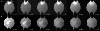 Figure 3 Distribution of GadoSpin™ M (A), GadoSpin™ D (B), GadoSpin™ P (C) in the vitreous model (100 % polyacrylamide-gel) and GadoSpin™ P in porcine vitreous body (D). Depending on the molecular weight the initial wavy injection tracks diffuses up to peripheral area of the vitreous model (A, B). Injecting macromolecular solution (C, D) the initial spot stays in effect for 12 h.