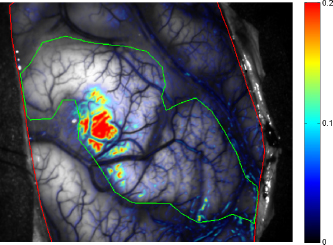 Figure 1 AxioCam MRm activity map for patient 8. Segmentation borders of postcentral gyrus are shown in green, borders of trepa-nation in red. Strength of activity is color coded from blue to red.