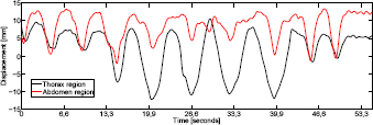 Figure 4 Comparison of two Kinect signals extracted from thoracic and abdominal regions of the chest. The signal of the thoracic region has a lower motion amplitude than the signal from the abdomen – with the exception of a period of forced thoracic breathing of the test person (starting from t=13 sec).