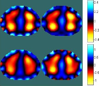 Figure 4 Upper row: Reconstructed conductivities at frame 8. Lower row: Reconstructed conductivities at frame 20. Left column: Reconstruction with traditional approach. Right column: Reconstruction with modified voltages based on stretched FEM model (simplified mesh).