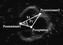 Figure 3 Ultrasound image of a porcine aortic root. For one leaflet, the commissure points Pcommissure1 and Pcommissure2, the coaptation point Pcoaptation and the geometrical features k1, F1 and α1 are shown.