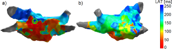 Figure 1 LAT map of the left atrium (LA) of Patient A in posteroanterior (PA) (a) and right anterior oblique (RAO) (b) view.