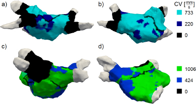 Figure 3 LA including estimated local CVs for Patient A (a, b) and Patient B (c, d) in PA (a, c) and RAO (b, d) view.
