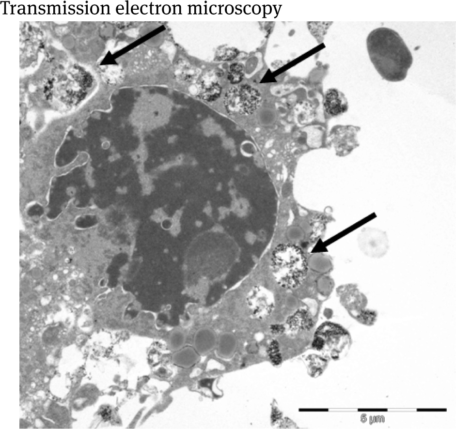 Figure 1 Macrophage presenting SPIOs within phagolysosomes (arrows) after incubation by 100 μl/mg Resovist-Fe over 24 hrs. The nucleus appears to be structurally normal. Bar = 5 μm.
