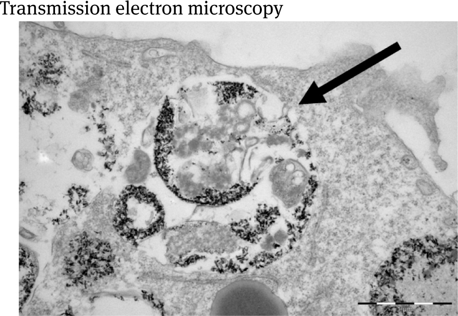 Figure 2 Magni_cation of an intra cellular MP phagolysosome (arrow) presenting SPIOs after incubation by 100 μl/mg Resovist-Fe over 24 hrs. Bar = 1 μm