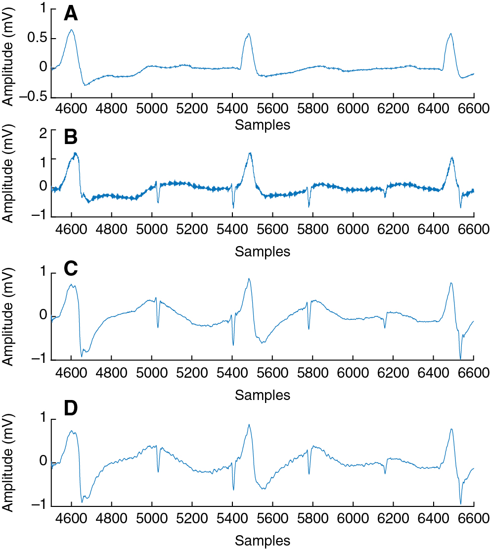 Figure 3 The EGM before filtering (B), after filtering using the peak detection algorithm (C) and after filtering using the f0 calculation (D). The signals in (C) and (D) are filtered with a band-pass of 1 Hz – 300 Hz. The reference ECG is illustrated in (A).