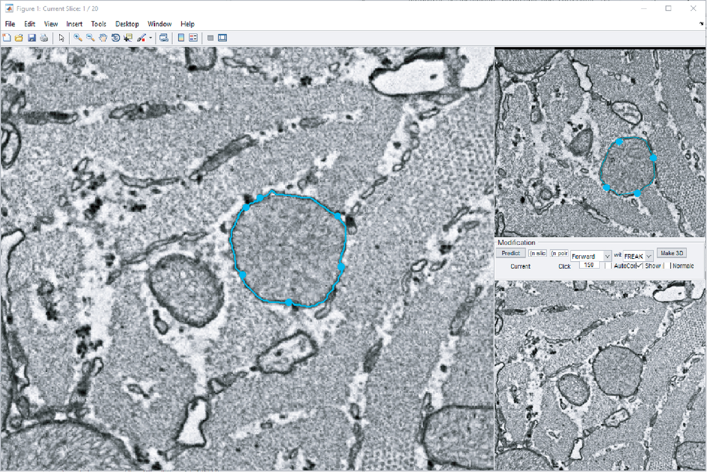 Figure 4 Screenshot of the MATLAB-based GUI prototype that consists of a main segmentation window (left), previews of adjacent slices and controls for the propagation algorithm (right).